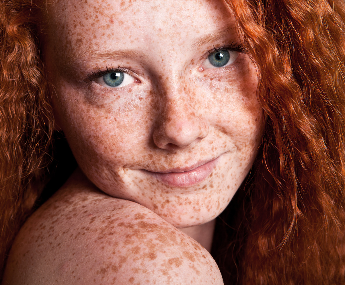 Girl Covered with Freckles